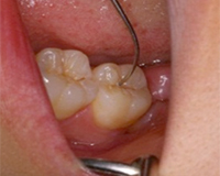 小さい虫歯