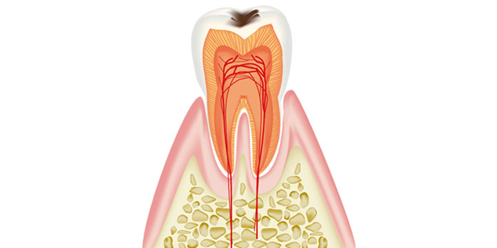 C1 エナメル質の虫歯